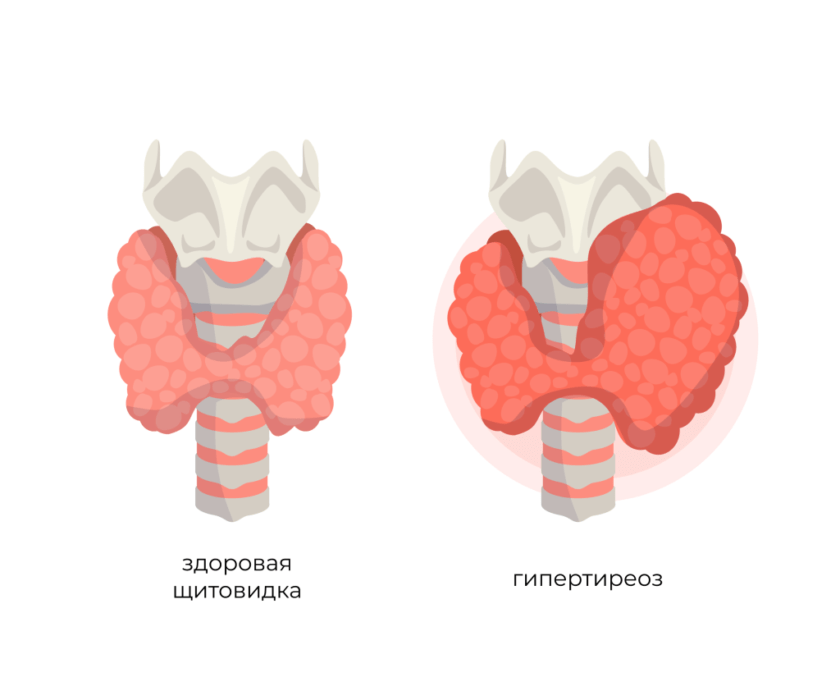 Щитовидная железа и рак